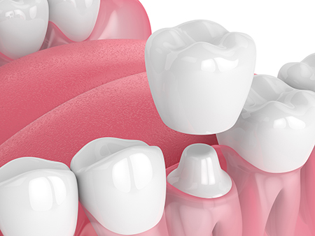 Maple Dental | Periodontal Treatment, Teeth Whitening and Digital Radiography
