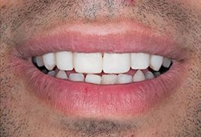 Maple Dental | Extractions, Dentures and Implant Dentistry
