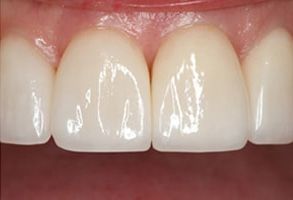 Maple Dental | Veneers, Pediatric Dentistry and Emergency Treatment