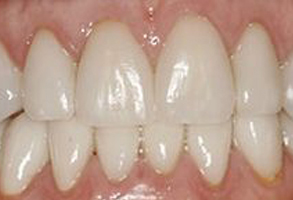 Maple Dental | Dentures, Night Guards and Invisalign®