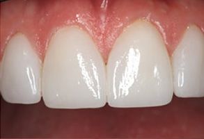 Maple Dental | Emergency Treatment, Extractions and Dental Bridges