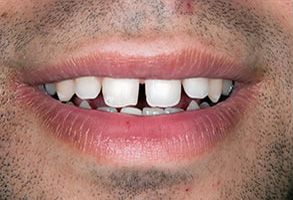 Maple Dental | Teeth Whitening, Dental Cleanings and Implant Dentistry