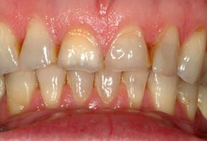 Maple Dental | Night Guards, Preventative Program and Veneers