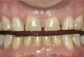 Maple Dental | Veneers, Invisalign® and Ceramic Crowns