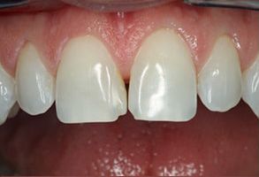 Maple Dental | Pediatric Dentistry, Oral Cancer Screening and Root Canals
